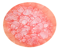 Psoriasis Treatment