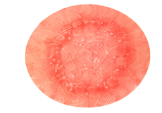 Ringworm Treatment