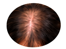 Hair Fall Treatment